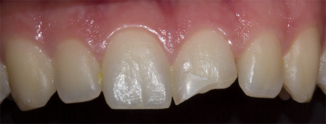 Implants Dentist in Lake Zurich