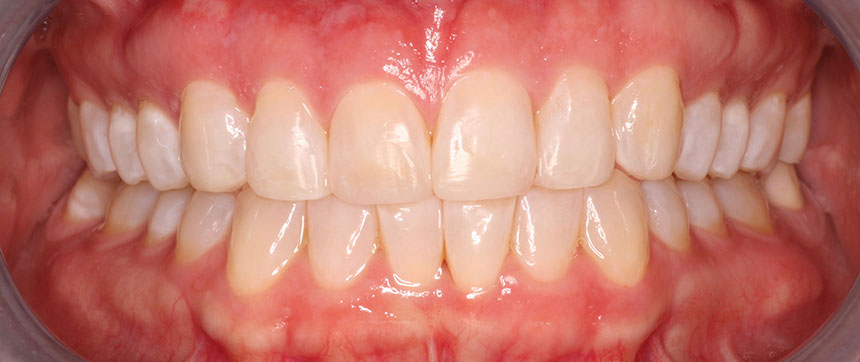 Implants Dentist in Lake Zurich