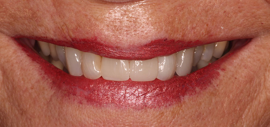 Implants Dentist in Lake Zurich