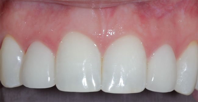 Implants Dentist in Lake Zurich